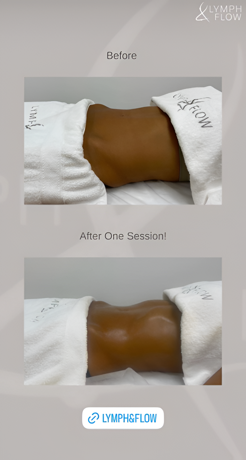 Legs before and after fluid retention treatment