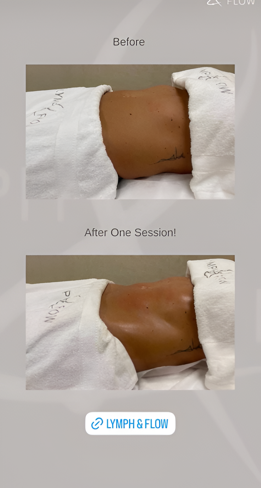 Arms post-operative recovery