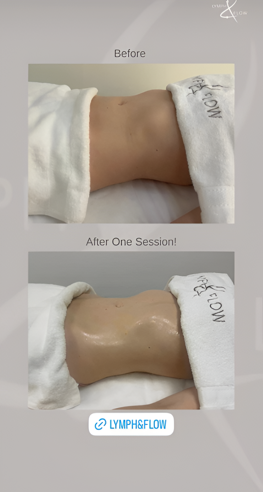 Arms post-operative recovery